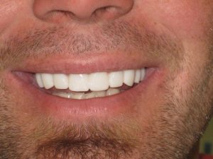 crown dentist after photo