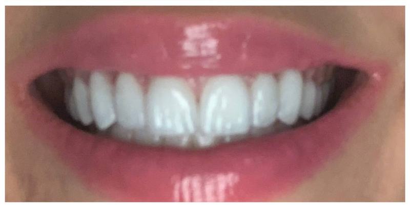 crown dentist after photo