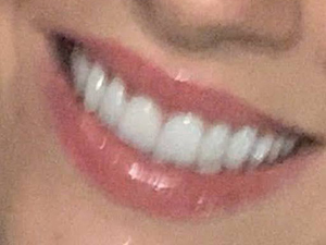 crown dentist after photo