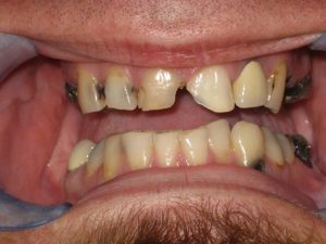 crown dentist before photo