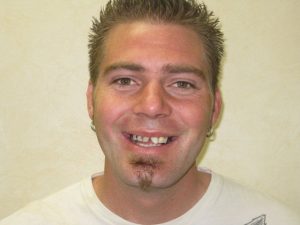 crown dentist before photo