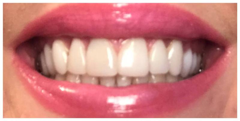 crown dentist before photo