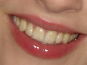 crown dentist before photo